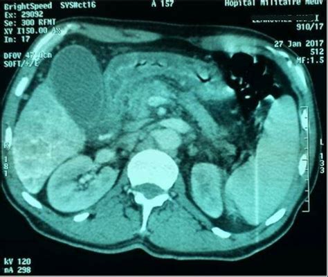 Abdominal Computed Tomography Demonstrated A Swelling Of The