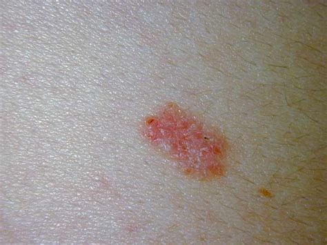 More Skin Cancer Lesions More Risk Medpage Today