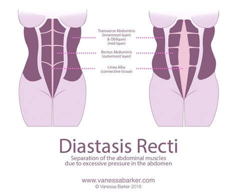 Do You Have Diastasis Recti Vanessa Barker Fitness