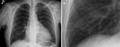 Endovascular Treatment of Pulmonary Artery Rupture from ...