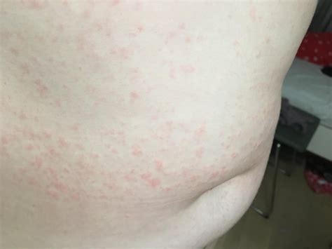 I Definitely Have Scabies But Have Developed A New Rash And Dont Know