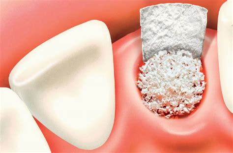 Bone Grafting For Dental Implants At Pacific Oral Surgery