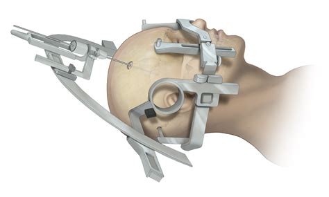 Stereotactic Brain Biopsy What The Patient Needs To Know Aaron Cohen