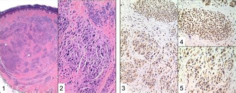 Maybe you would like to learn more about one of these? BAP1 cancer syndrome: malignant mesothelioma, uveal and ...