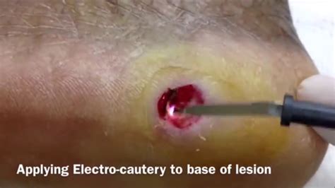 Lesions Cysts Boils Pimples Popping Information Youtube