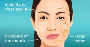 Facial Nerve Paralysis Bell S Palsy NAMAT Blog