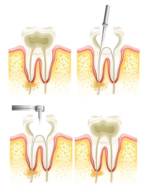 It consists of the pulp chamber (within the coronal part of the tooth), the main canal(s), and more intricate anatomical branches that may connect the root canals to each other or to the surface of the root. Does Root canal really save the teeth? - Dentist Plano TX ...