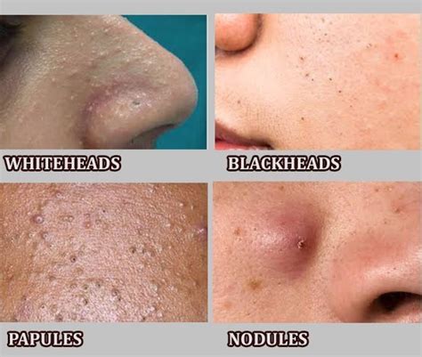 What Type Of Pimples You Have And How To Get Rid Of Them