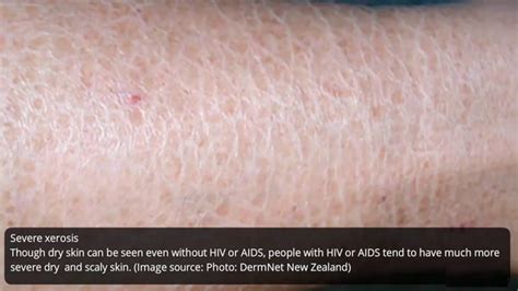 Hiv Skin Rash Naturalskins