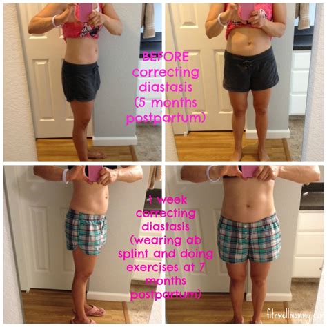 How to prevent diastasis recti after pregnancy. My Diastasis Recti Journey - Deliciously Fit