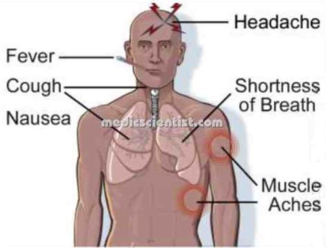 Bird flu viruses infect birds, including chickens, other poultry bird flu illness in people can range from mild to severe. Bird Flu Avian Influenza Diagnosis Causative Virus Signs and Symptoms With Treatment ...