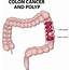 Colorectal Cancer  Health Beat