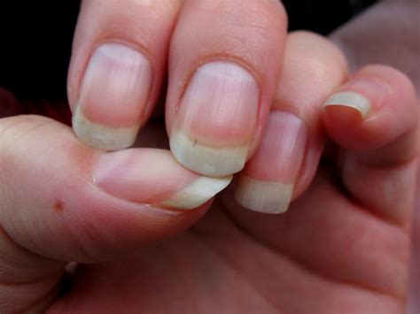 Symptoms Of Hand Nail Fungus