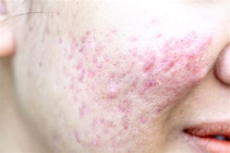 Backgrounds Of Lesions Skin Caused By Acne On The Face Stock Photo