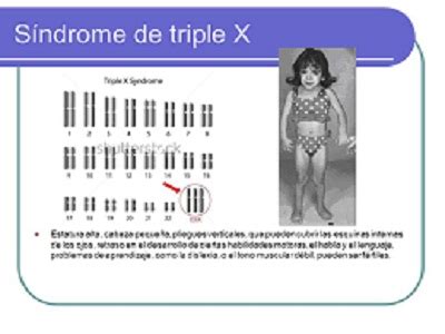 Síndrome de triple X EcuRed