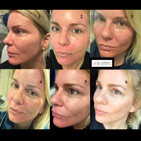Collection 100 Pictures Deep Chemical Peel Before And After Photos Completed