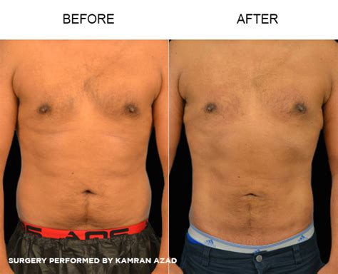 Photo Gallery Tampa Liposuction By Dr Basssin