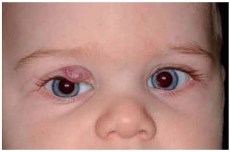 Vascular Tumors Of The Eyelids Ento Key