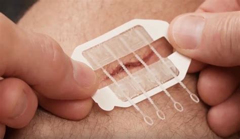 Zipstitch Is New Way To Close Wounds When Youre Out There And Cant