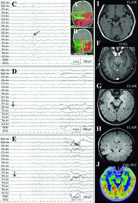 A B Interictal Electroencephalography Eeg Demonstrates Paroxysmal