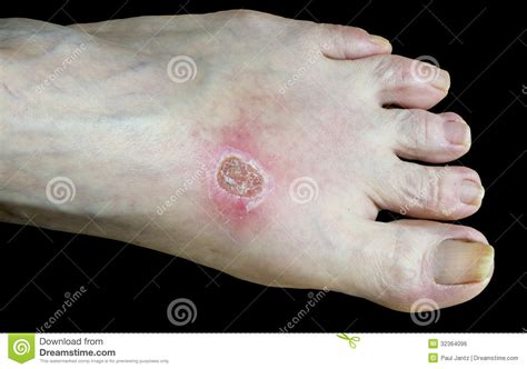 Develop at reception of hot food or the boiling liquids. Burned Foot Royalty Free Stock Image - Image: 32364096