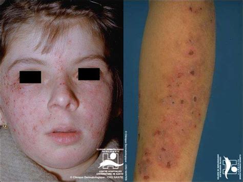 Porphyria Cutanea Tarda Порфирия кожная медленная презентация онлайн