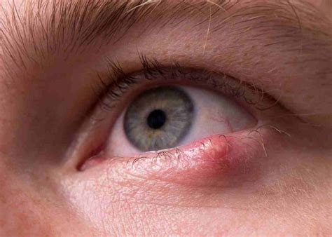 Chalazion Eyelid Cyst Or Meibomian Cyst Lump In Eyelid Causes Sexiz Pix