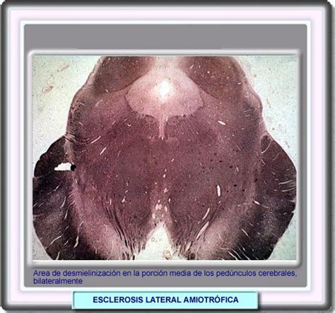 18/06/2020 14 la esclerosis lateral amiotrófica, también conocida como ela o como enfermedad de lou gehrig, es. ATLAS DE NEUROLOGIA