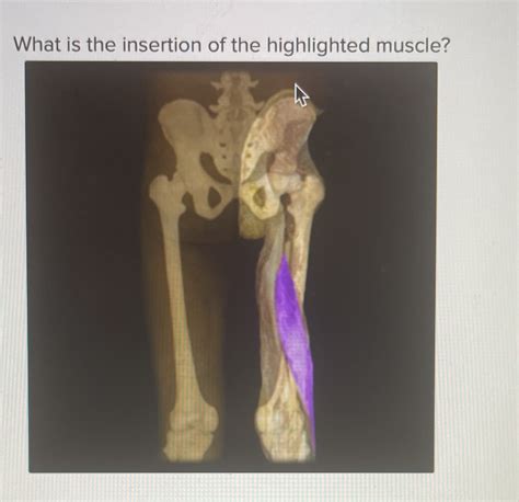 Solved Head Of Fibula Tibial Tuberosity Patella Lesser Trochanter