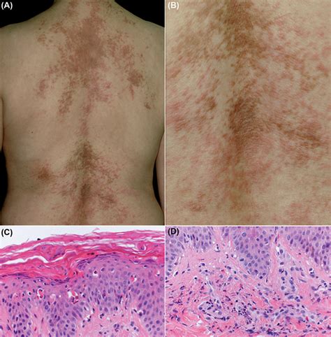 Prurigo Pigmentosa Like Persistent Papules And Plaques In A Patient