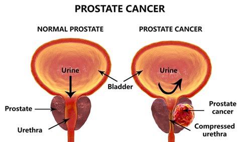 Your treatment depends on a number of factors including how big the cancer is, whether it has spread anywhere else in your body and your general health. Theresa May to launch £75m drive against prostate cancer