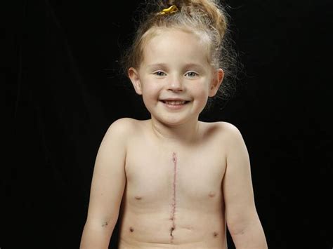 Victorias ‘zipper Kids Look Forward To Christmas After Heart Surgery