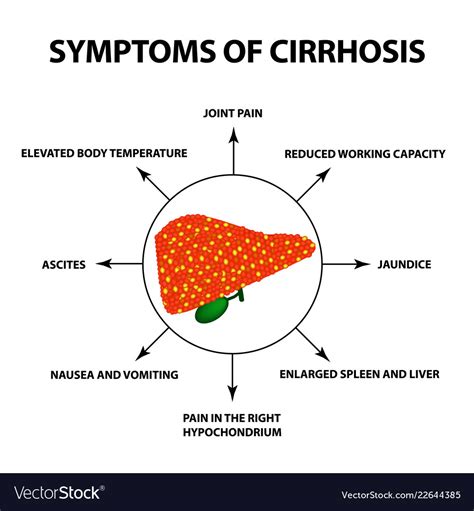 Symptoms Of Cirrhosis Infographics Royalty Free Vector Image