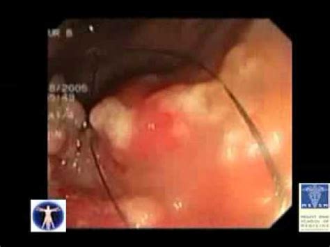 Should you see your dog collapse, you need to immediately take them to the vet. Colonoscopy Demonstrating Colon Cancer - YouTube