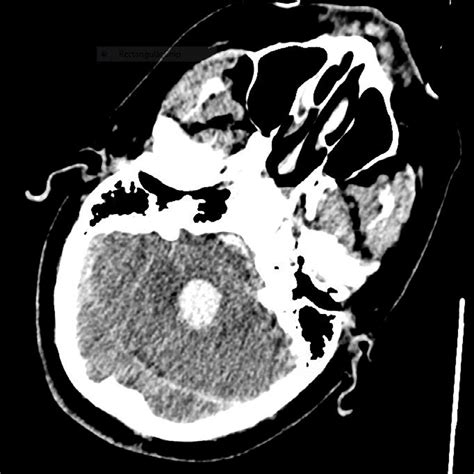 Ct Of Head Axial Image Showing Hemorrhage Extending Down Into Dilated