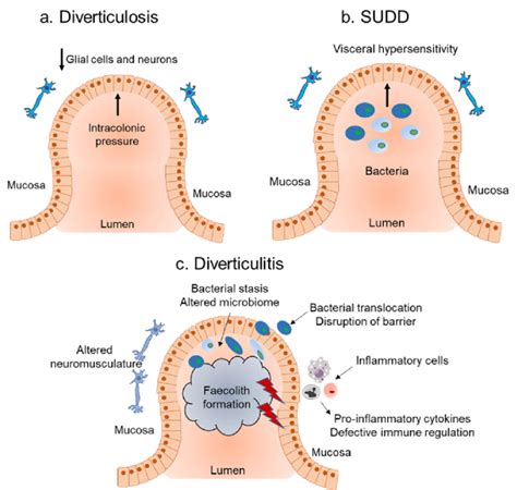 Diverticulosis Diverticular Disease And Diverticulitis Uk