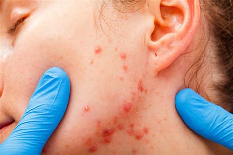Acne In Children Causes Symptoms And Treatment