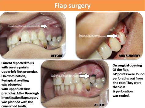 During the first few days, you may experience swelling in your cheeks and mouth, which gradually eases off. Wisdom Tooth Removal in Pune|Cost of Wisdom Tooth ...