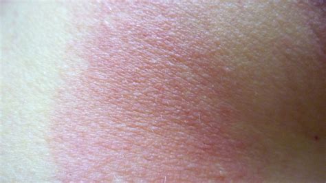 Download Itchy Dry Skin Rash Pictures | Dorothee Padraig South West ...