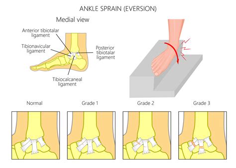 Ankle Sprains Treatment Options Bakewell Osteopathy Clinic