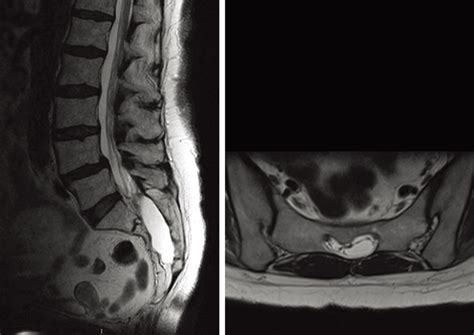 Perineural Cysts Pictures