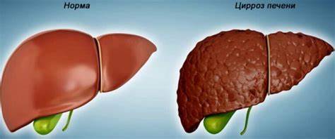 Цирроз симптомы диета Цирроз печени - симптомы, лечение, стадии, причины, диета Цирроз печени - симптомы, лечение, стадии, причины, диета Цирроз симптомы диета