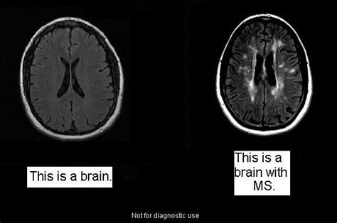 Normal Brain Ms Brain Mri Brain Multiple Sclerosis Awareness
