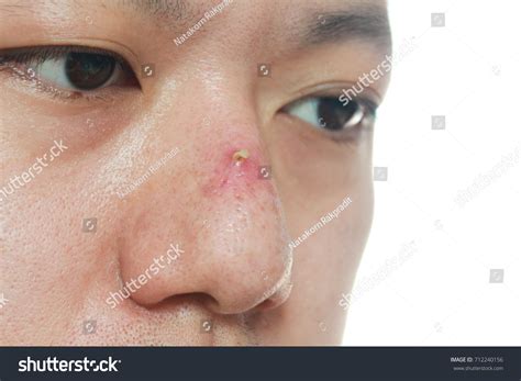 Infected Pimple On Nose Asian Young Stock Photo 712240156 Shutterstock