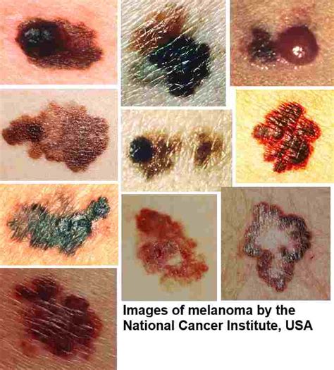Warning Signs Of Melanoma The Most Deadly Form Of Skin Cancer