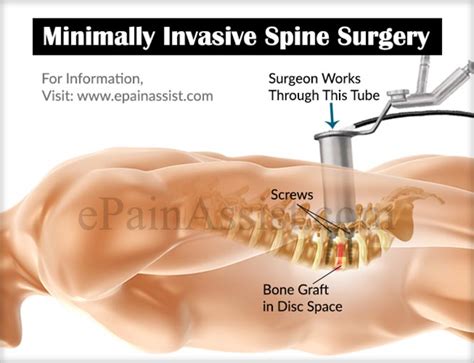 Minimally Invasive Spine Surgery Types Recovery How Is It Done