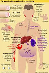 Cirrhosis leading to Chronic Liver Failure - Clinical ... - GrepMed Cirrhosis  