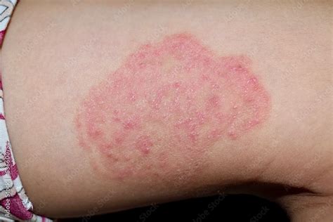 Fungal Infection Called Tinea Corporis In Thigh Of Asian Child