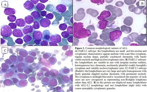 Acute Lymphocytic Leukemia All 네이버 블로그