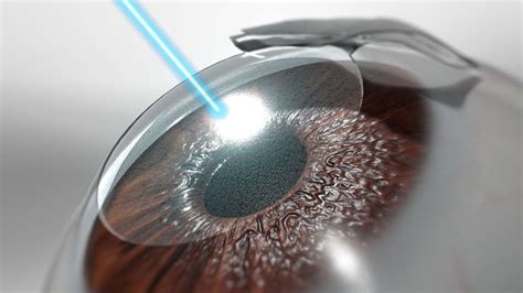 How Does Laser Eye Surgery Improve Vision Techshim